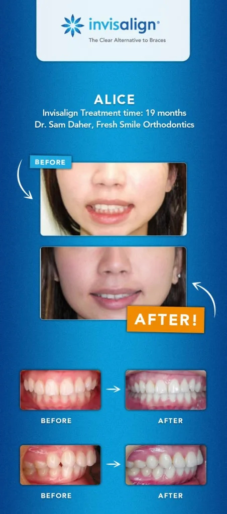 invisalign results fix overbite_alice